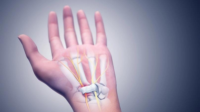A medical picture showing Carpal Tunnel Syndrome